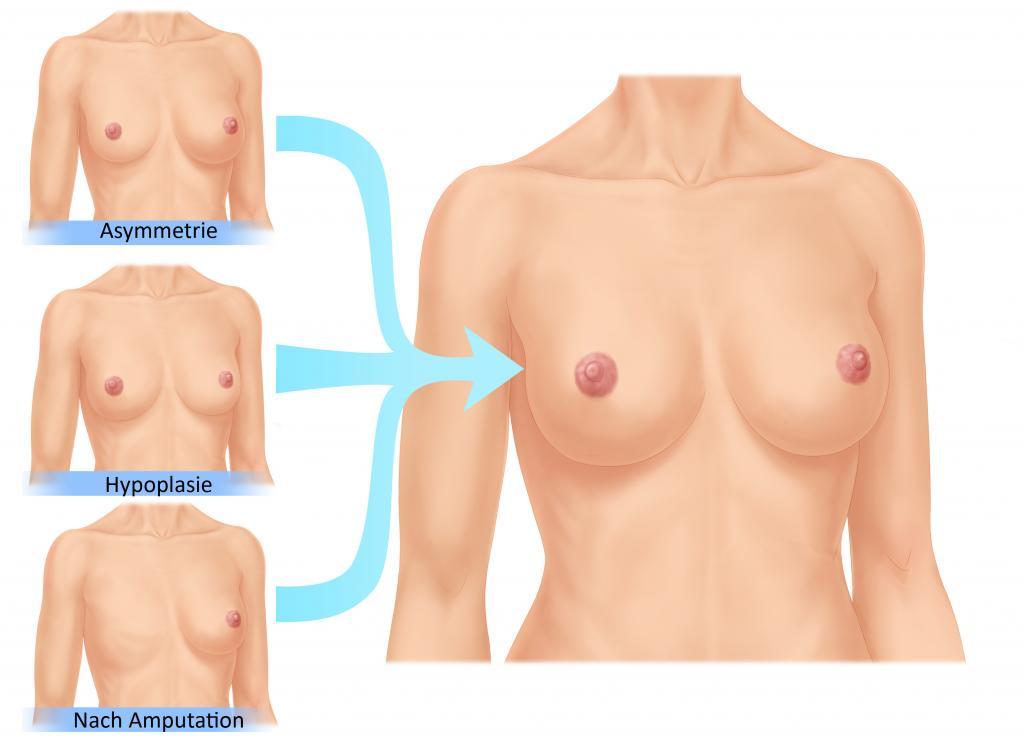 Brustvergößerung Gründe
